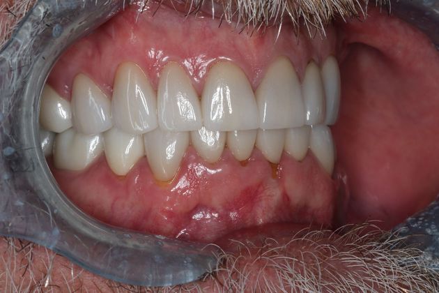 Full Mouth Reconstruction: Case 8 - After