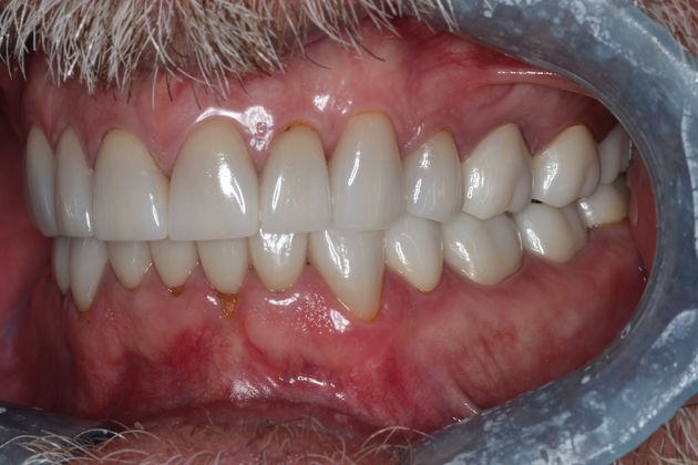 Full Mouth Reconstruction: Case 8 - After
