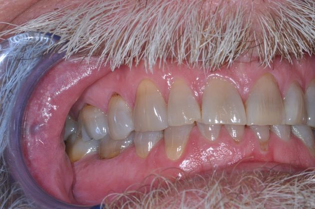 Full Mouth Reconstruction: Case 8 - Before