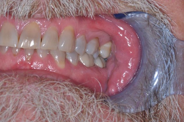 Full Mouth Reconstruction: Case 8 - Before