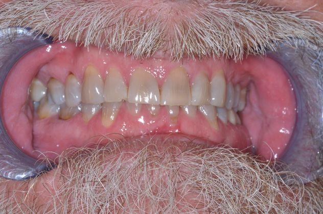 Full Mouth Reconstruction Case 8 - Before