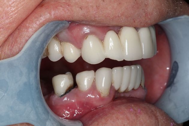 Teeth In A Day: Case 24 - Before