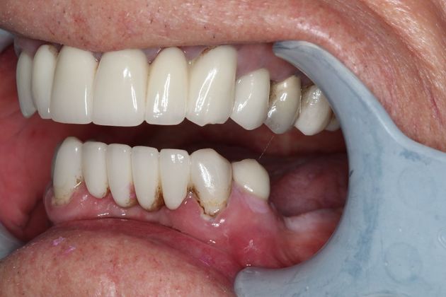 Teeth In A Day Case 24 - Before