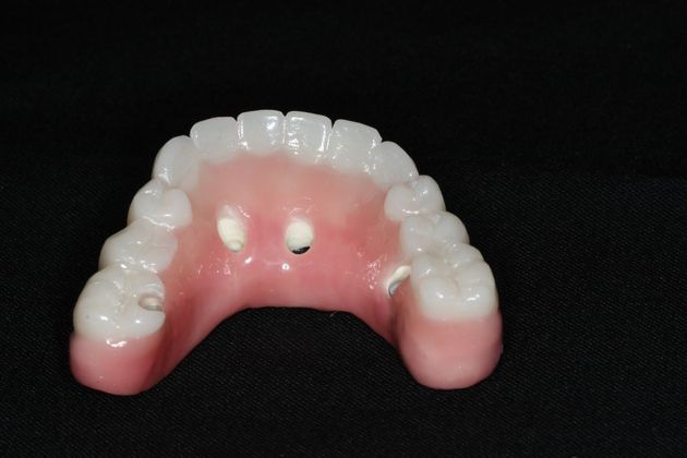 Teeth In A Day: Case 24 - After