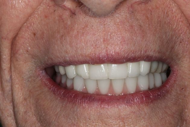 Teeth In A Day Case 24 - After