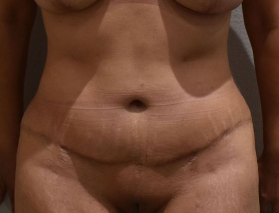 Tummy Tuck (Abdominoplasty): Case 337 - After