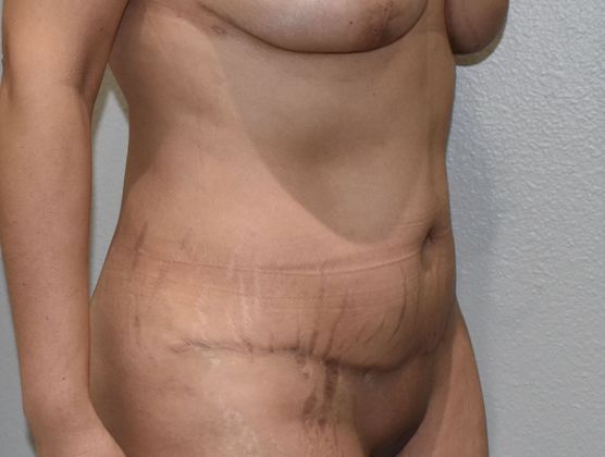 Tummy Tuck (Abdominoplasty): Case 337 - After