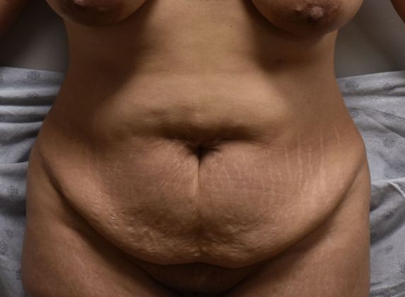 Tummy Tuck (Abdominoplasty): Case 337 - Before