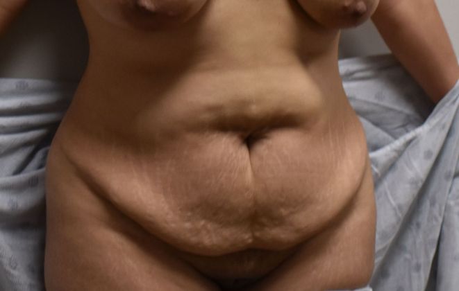 Tummy Tuck (Abdominoplasty): Case 337 - Before