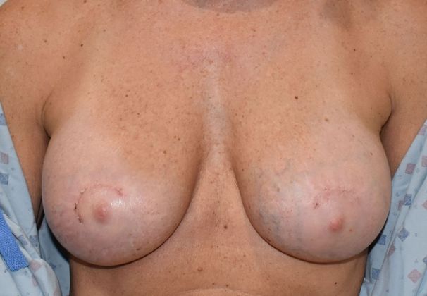 Breast Revision: Case 183 - After