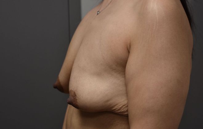 Massive Weight Loss : Case 99 - Before