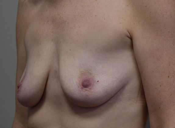 Breast Augmentation w/ Lift: Case 420 - Before
