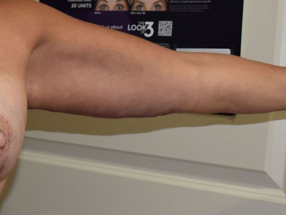 Brachioplasty: Case 15 - After