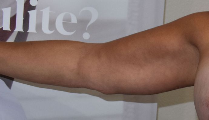 Brachioplasty Case 15 - After