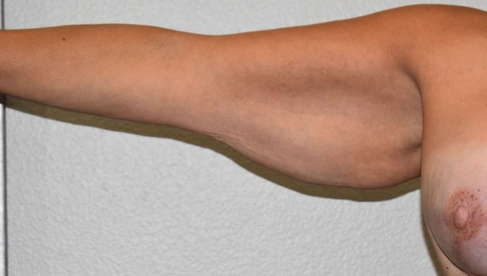 Brachioplasty Case 15 - Before