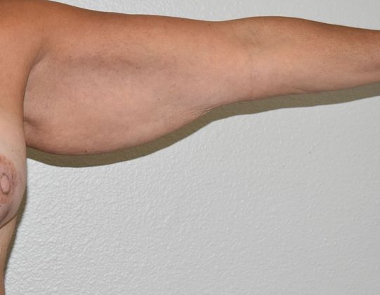 Brachioplasty: Case 15 - Before
