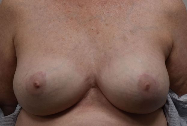 Breast Revision: Case 187 - After