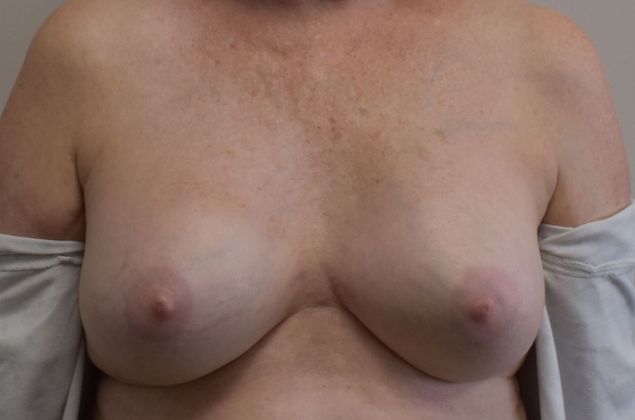 Breast Revision: Case 187 - Before