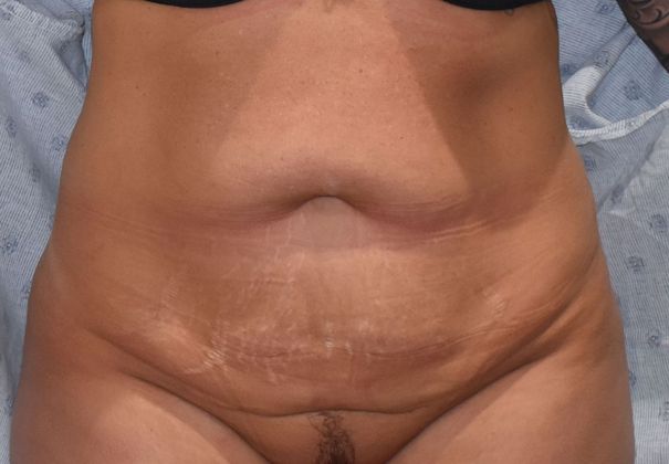 Tummy Tuck (Abdominoplasty): Case 339 - Before