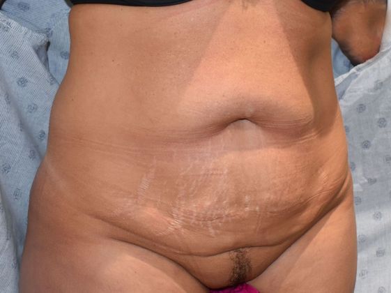 Tummy Tuck (Abdominoplasty): Case 339 - Before