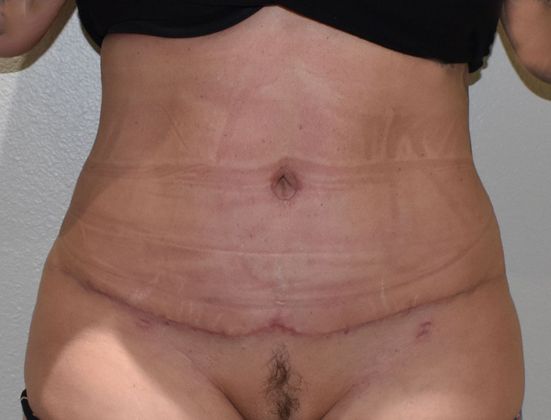 Tummy Tuck (Abdominoplasty): Case 339 - After