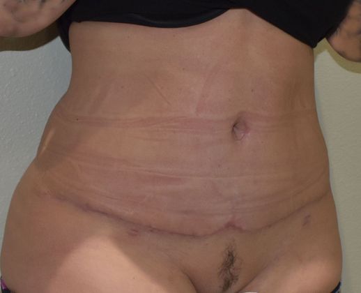 Tummy Tuck (Abdominoplasty): Case 339 - After