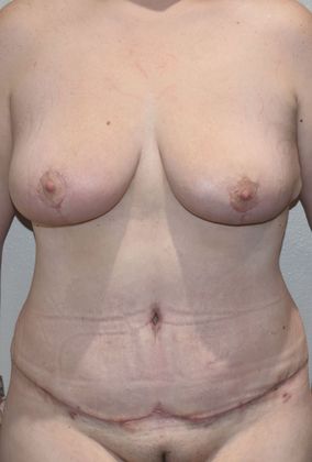 Massive Weight Loss : Case 100 - After