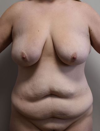 Massive Weight Loss : Case 100 - Before