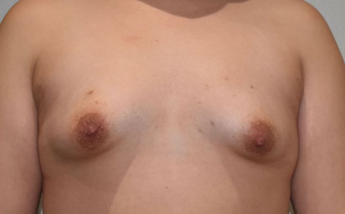 Breast Augmentation Case 694 - Before