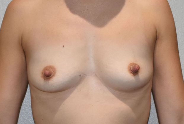 Breast Augmentation Case 695 - Before
