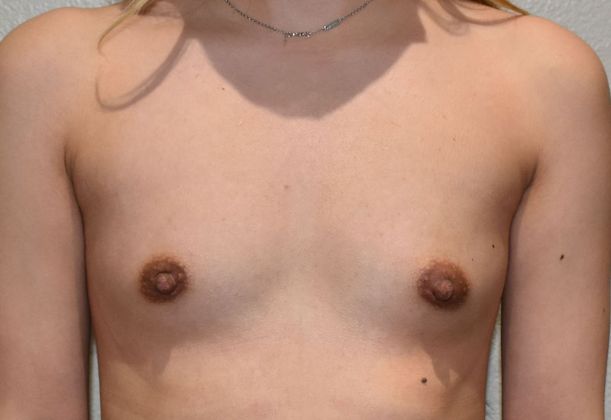 Breast Augmentation Case 696 - Before