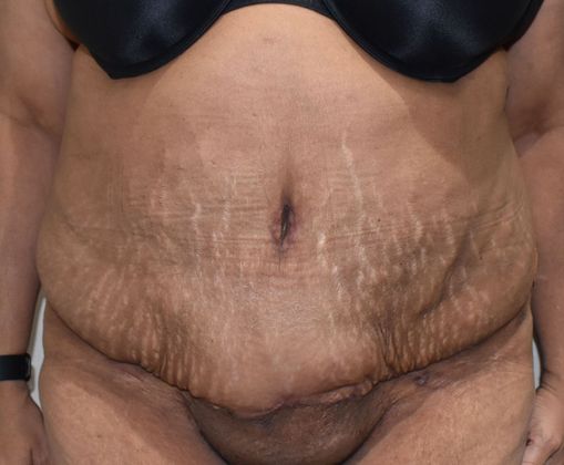 Massive Weight Loss : Case 101 - After