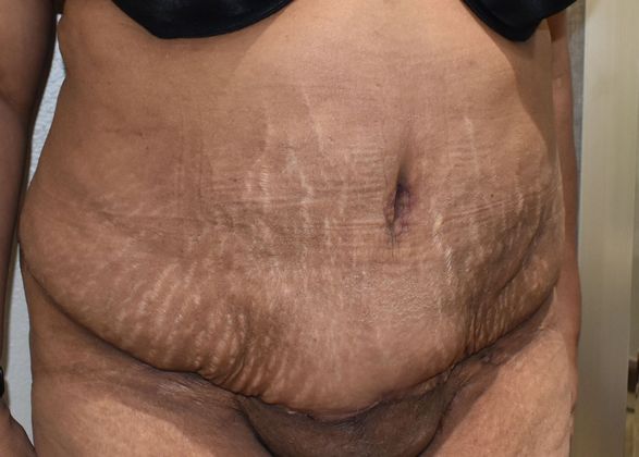 Massive Weight Loss : Case 101 - After