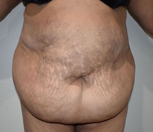 Massive Weight Loss : Case 101 - Before