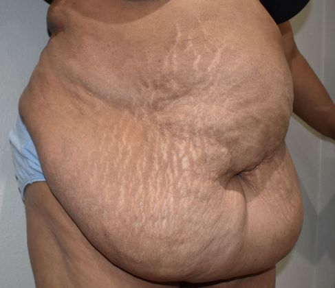 Massive Weight Loss : Case 101 - Before