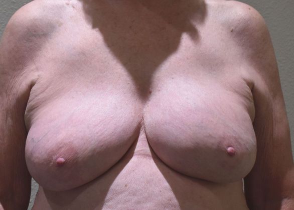 Breast Revision: Case 189 - Before
