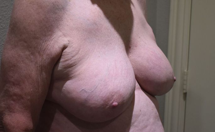 Breast Revision: Case 189 - Before