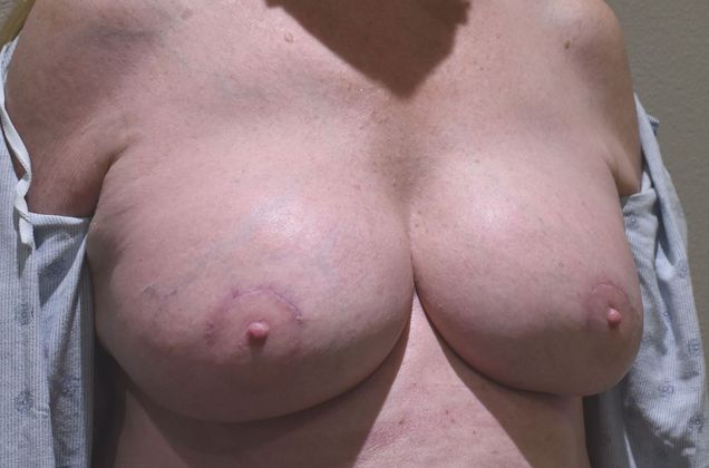 Breast Revision: Case 189 - After