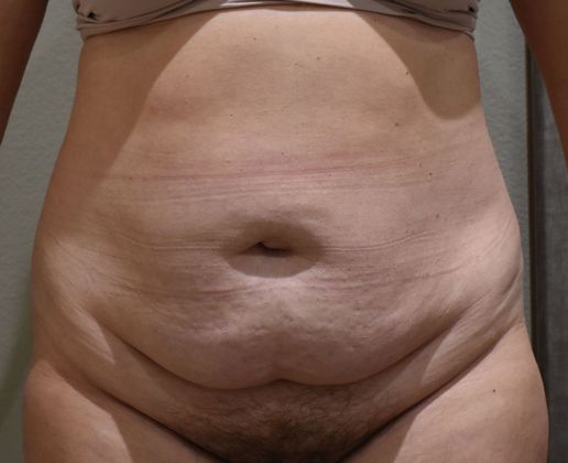 Tummy Tuck (Abdominoplasty): Case 343 - Before