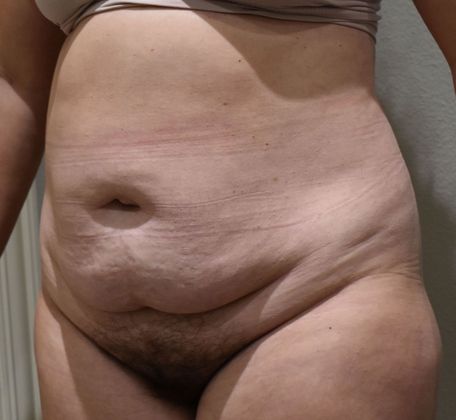 Tummy Tuck (Abdominoplasty): Case 343 - Before