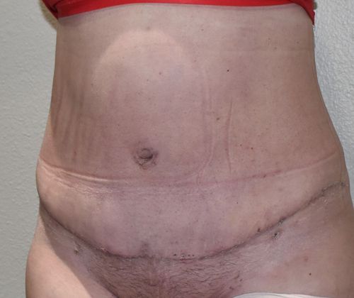 Tummy Tuck (Abdominoplasty): Case 343 - After