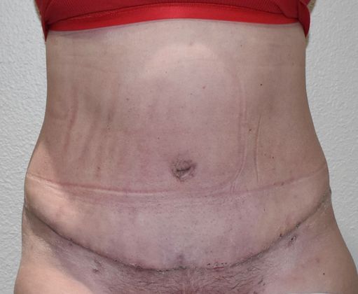 Tummy Tuck (Abdominoplasty): Case 343 - After