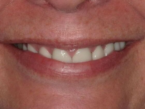 Dental Crowns Case 1 - After