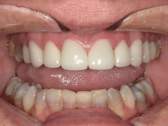 Dental Crowns: Case 1 - After