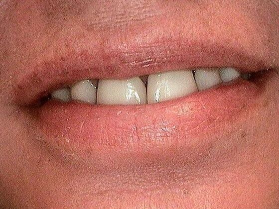 Dental Crowns Case 1 - Before