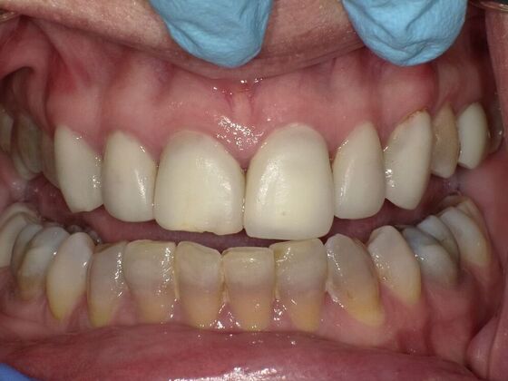 Dental Crowns: Case 1 - Before