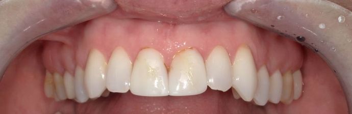 Dental Crowns Case 2 - Before