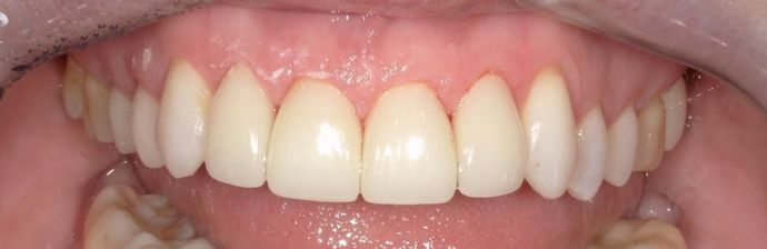 Dental Crowns Case 2 - After