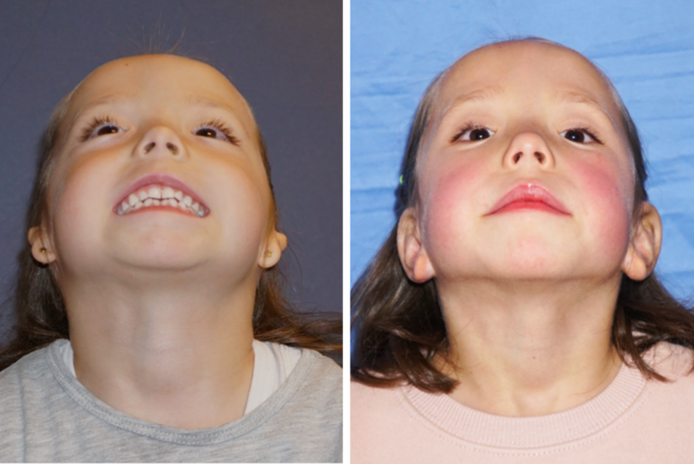 Both Ears: Before & After - BEFORE & AFTER 4yr. old girl after combined ear & canal reconstruction of both ears