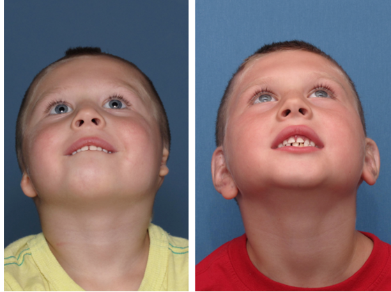 Both Ears: Before & After